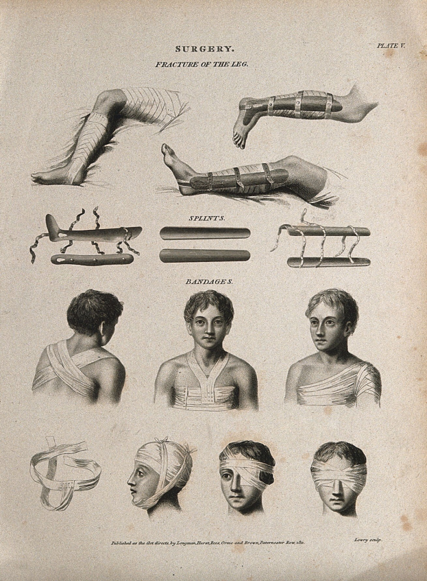 Alte Buchillustration mit einem Mannsbeinen und einem Frauenkopf mit bandagierten Köpfen, begleitet von Text.